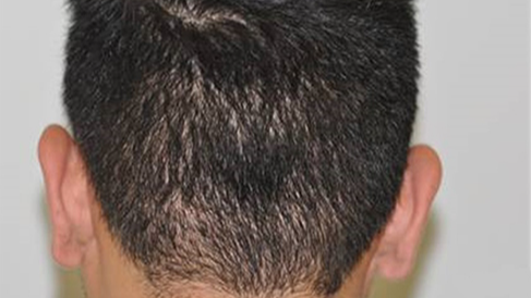 Say Goodbye to Hair Loss With Top Transplant & Restoration Clinic In Houston