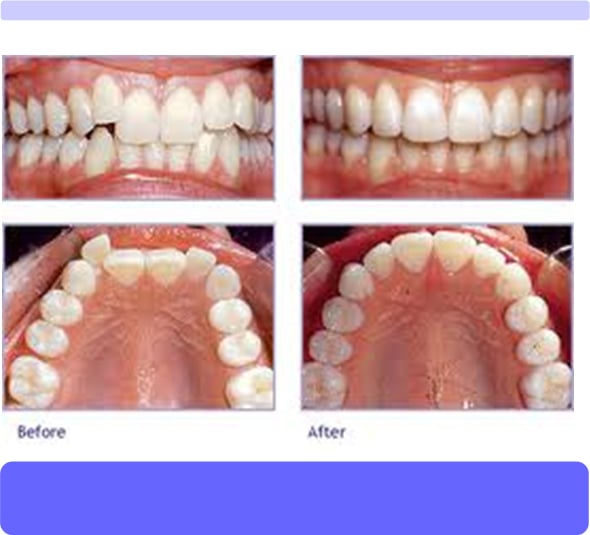 Achieve A Straight Smile By Visiting Carmel, IN Invisible Braces Dental Experts