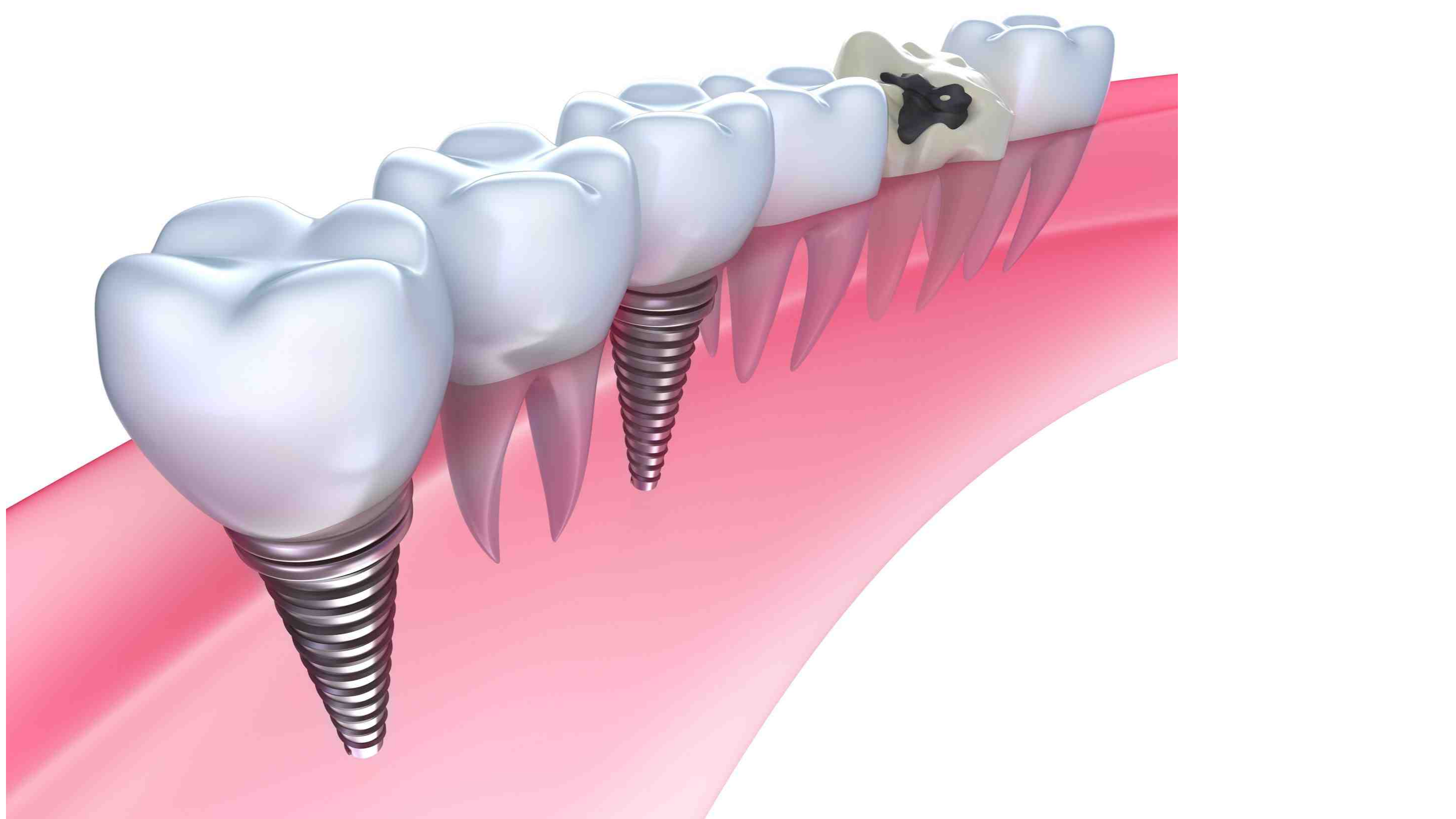 Call Top Jersey City Dental Team For Reliable Implant Installations & Advice