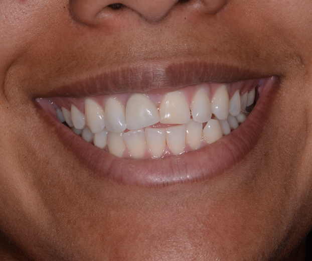 Top Cosmetic Dentist Offers Full Arch Teeth Replacement Procedures In Little Elm