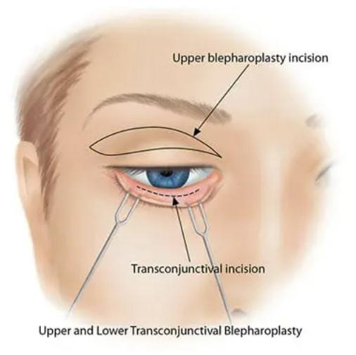 Blepharoplasty Risks & Complications, Eyelid Surgery Insights From Top Surgeon