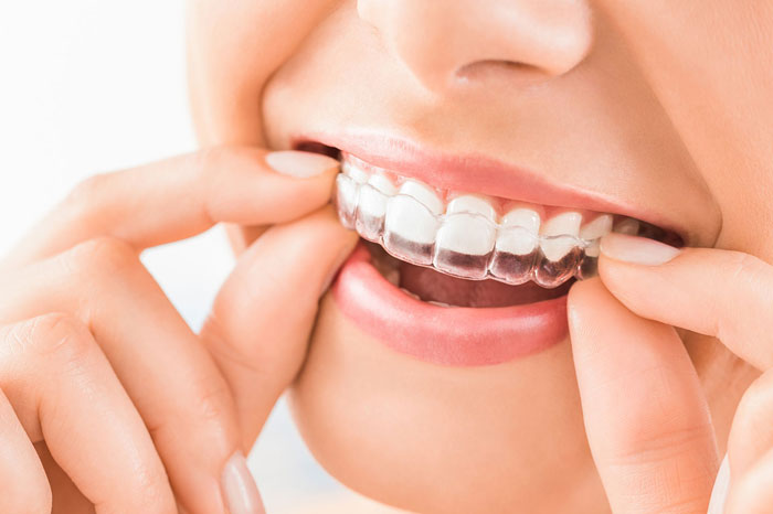 Milton, WA Orthodontist Offers Clear Invisalign Aligners For Teeth Straightening