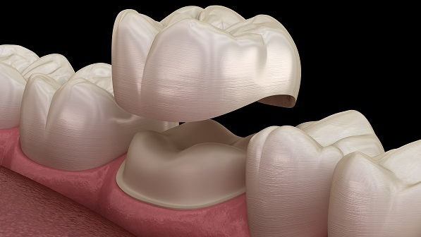 Need a New Dental Crown? One-Day Crowns Now Available From The Gilbert Dentist