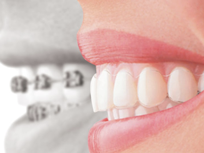 The Best Power Ranch AZ Clear Braces: Straighten Your Misaligned & Crooked Teeth
