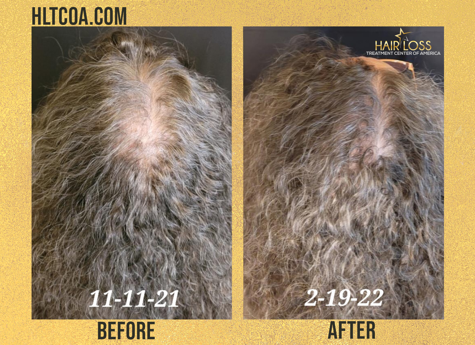 Get The Best Hair Recovery Treatment & Trichology Assessment For Alopecia