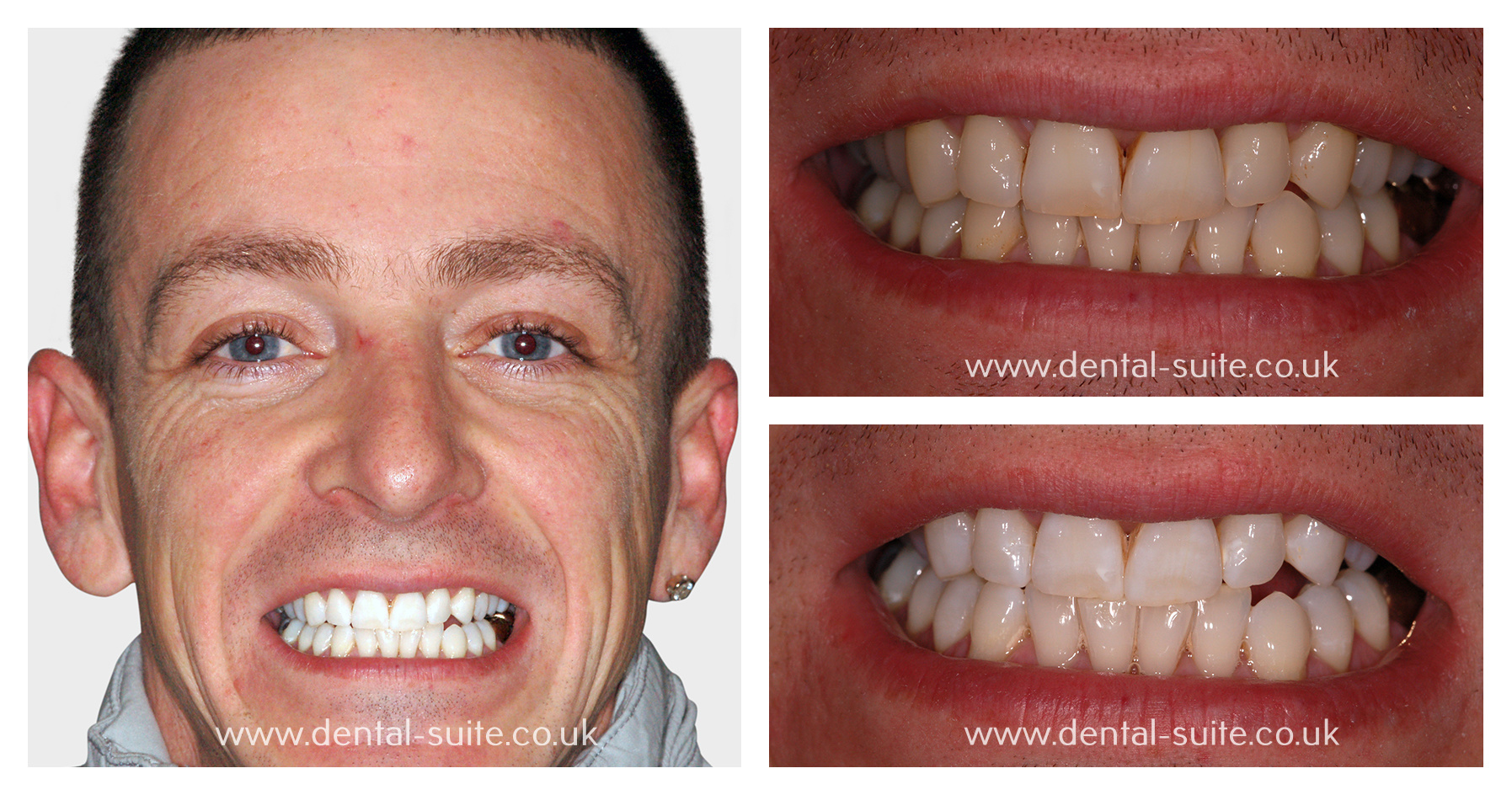 Have Whiter Teeth With Safe & Effective Teeth Bleaching Service In Carmel, IN