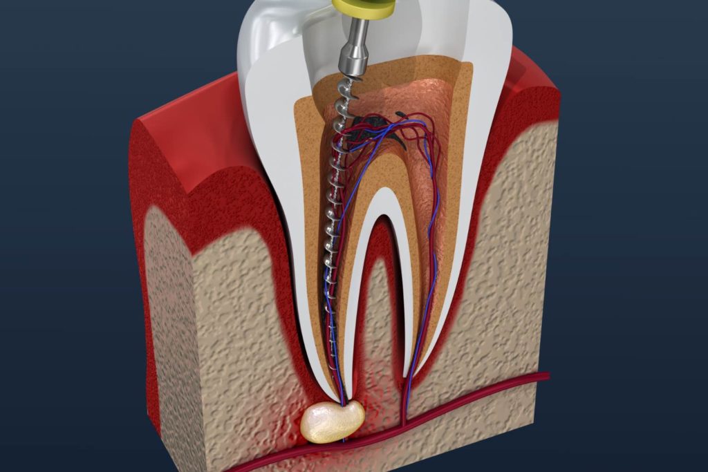 Get Fast Treatment For Your Cracked Tooth At This Bellaire Dental Practice