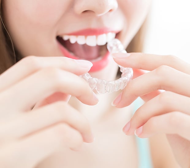 Invisalign Clear Braces/Aligners In Auburn, WA - Straighten Teeth Without Wires