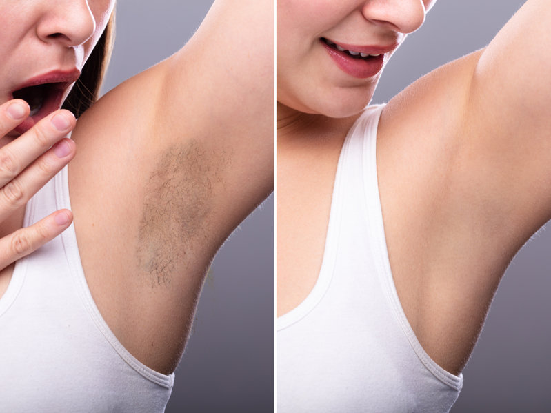 Get Painless Laser Hair Removal Treatment For Any Skin Type In Agoura Hills, CA