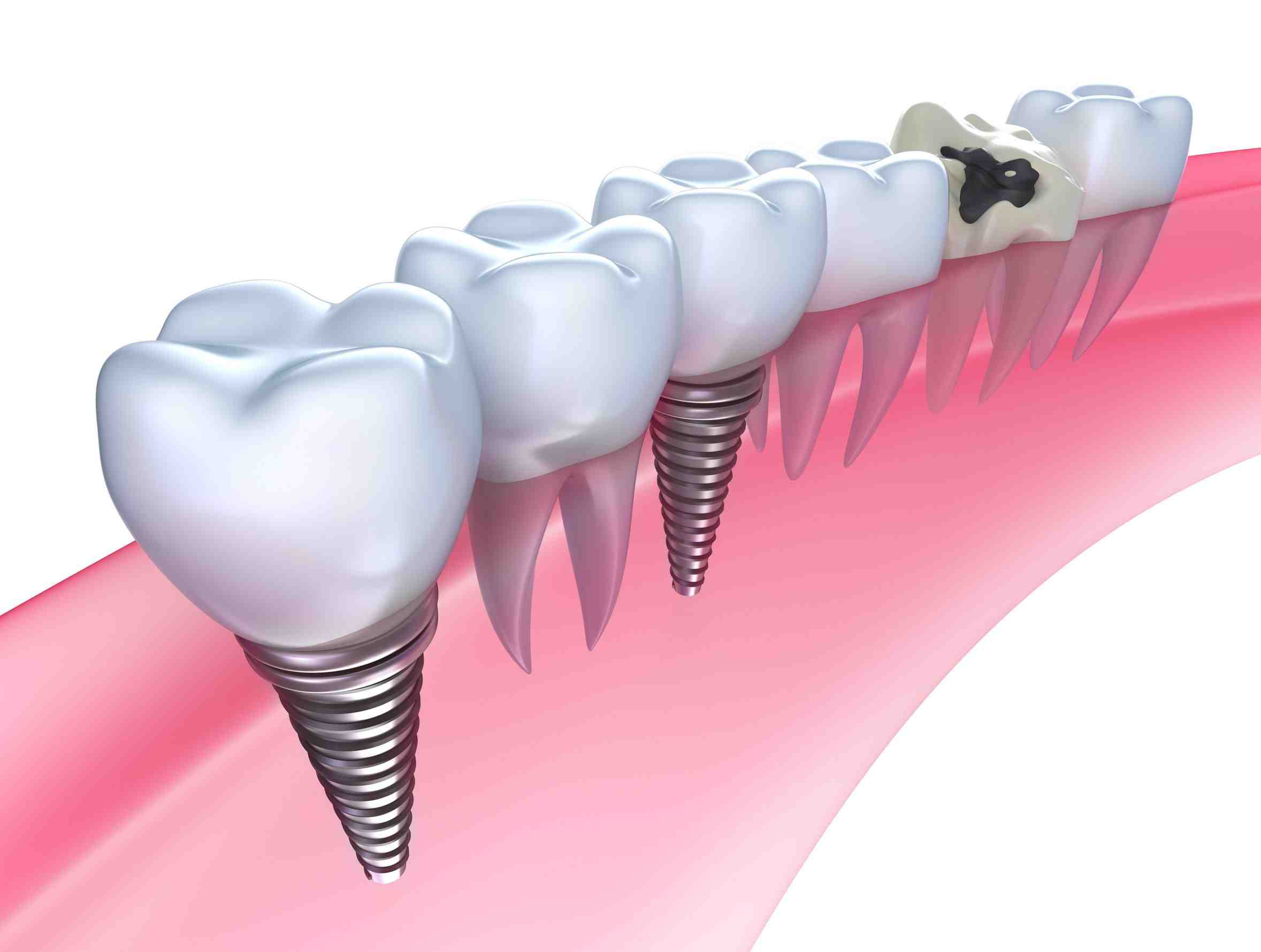 Jersey City Same-Day Implants Are Ideal Restorative Dentistry Options