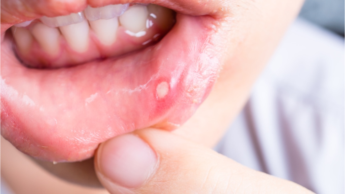 Got Painful Canker Sores? Get Lasered By Dr. Brown in Gilbert, AZ