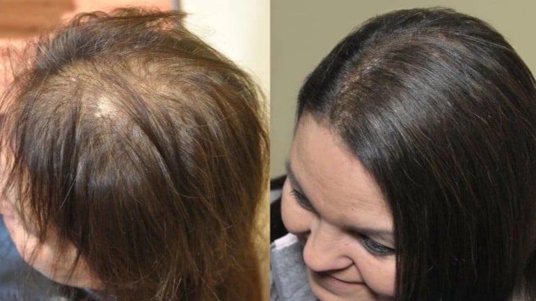 Is Female Androgenetic Alopecia Reversible? Hair Experts Share Signs & Solutions
