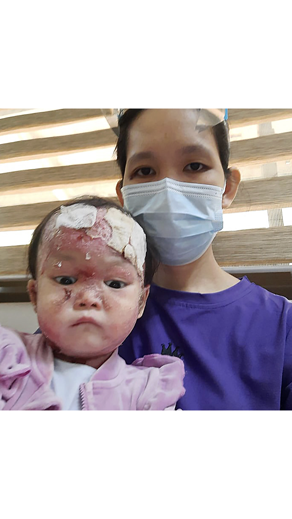 What Is Epidermolysis Bullosa Caused By? Impact On Babies & How You Can Help