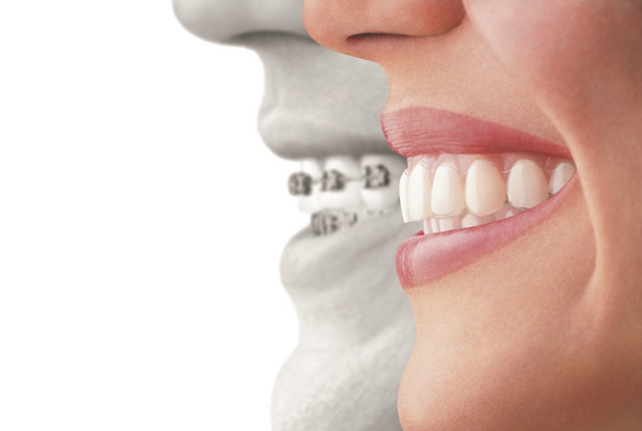 Get The Best Invisible Braces In Browns Point: Straighten Your Teeth Fast