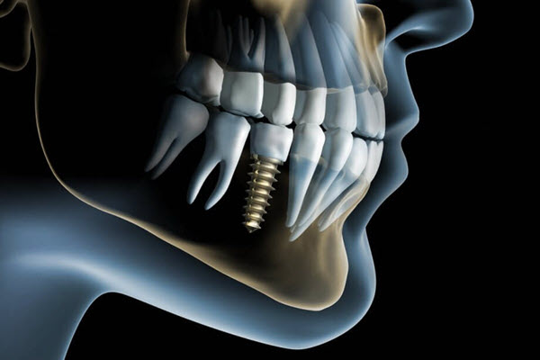 Best Price Discount Value Dental Implants Available From Auckland, NZ Dentist