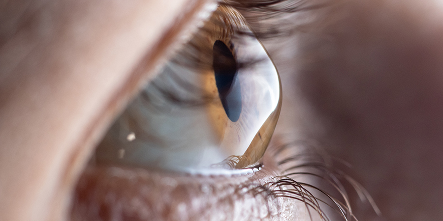 See How to Treat and Prevent Keratoconus | Eyes Now