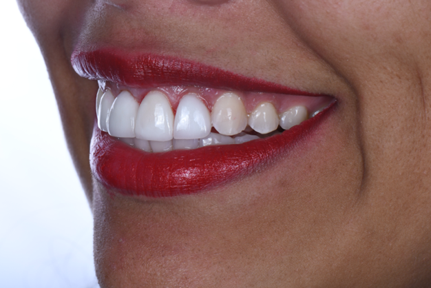 #1 Dental Implant Dentist In Plano: Get Single Missing Tooth Replacement