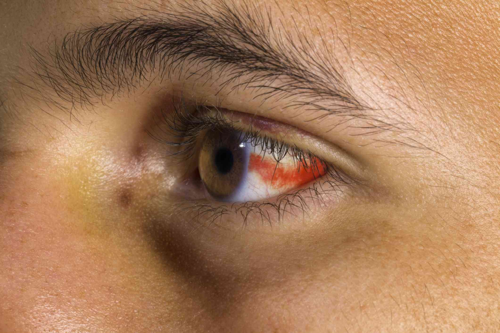 眼睛频繁出现红血丝是为什么呢？ - 知乎
