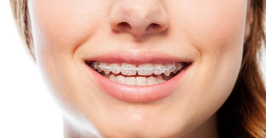Fife, WA Family Orthodontist Offers Invisalign Braces For A Beautiful Smile