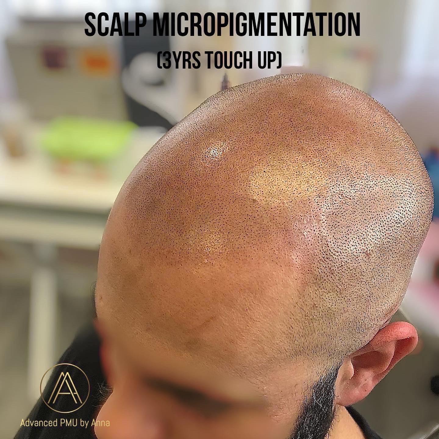 Get The Best Micropigmentation Procedure For Receding Hairline In Woodland Hills