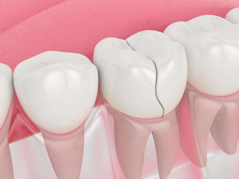 Get The Best Memorial, Houston Critical Dental Care For Chipped & Broken Teeth