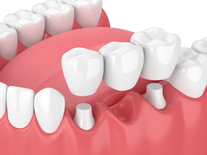 This Family Dentist In Bellaire, TX Offers The Best Dental Bridges & Crowns