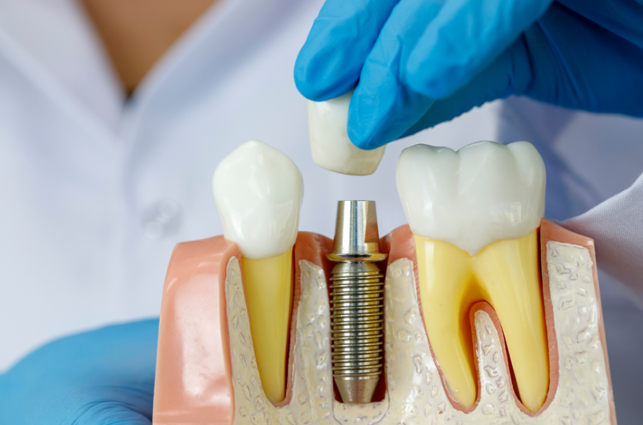Get The Best Bellaire, Houston Dental Service For Teeth Implants & PPO Coverage