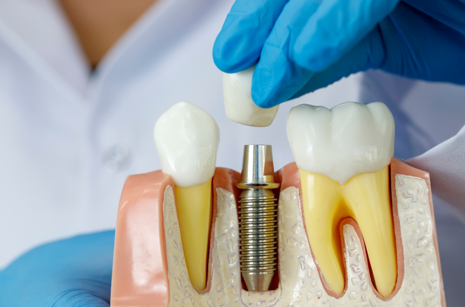 Get Root Canal Treatment For Injured Teeth At Chinatown, Houston Dental Office