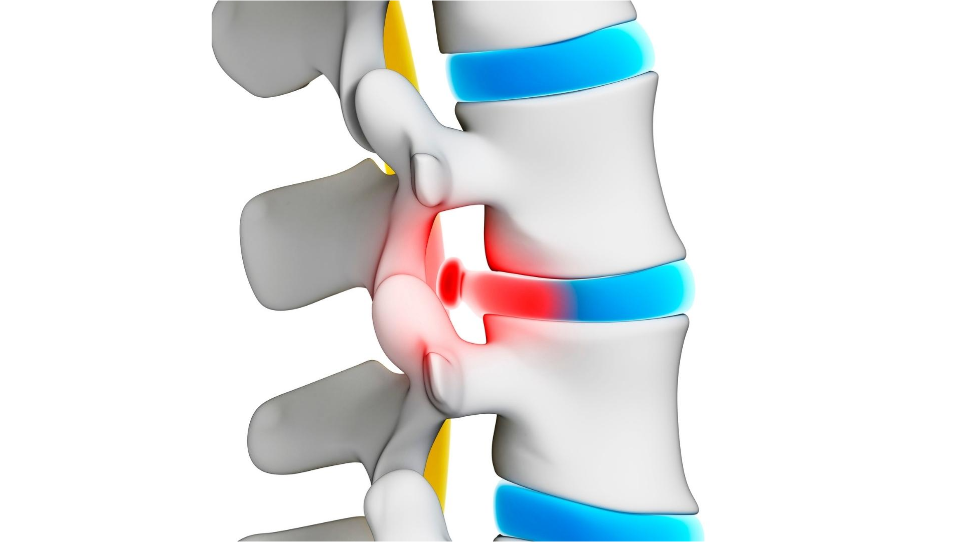 Bulging Disc Non-Surgical Treatments