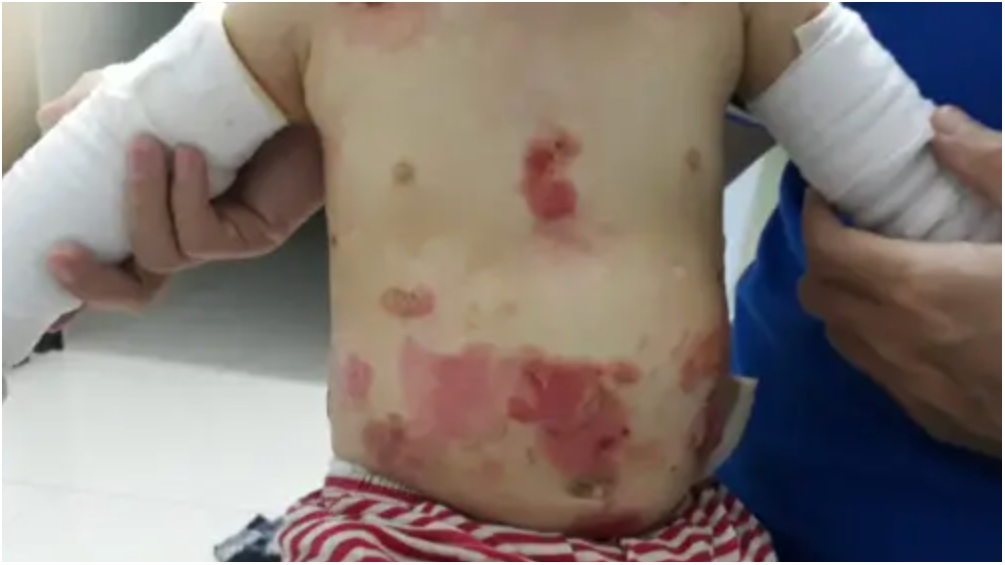 Epidermolysis Bullosa In Babies: Causes, Survival & How You Can Help
