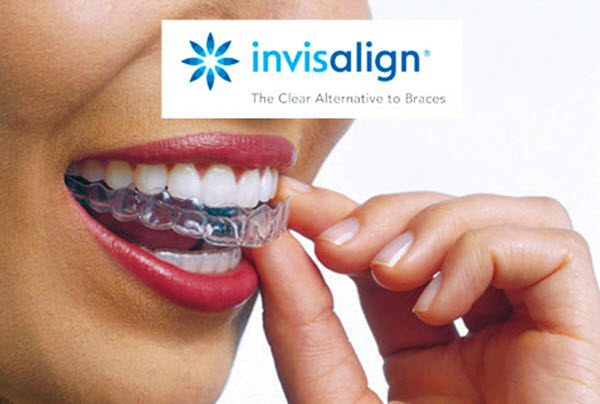 Affordable Invisalign Alternatives At Home/DIY Orthodontics New Lynn