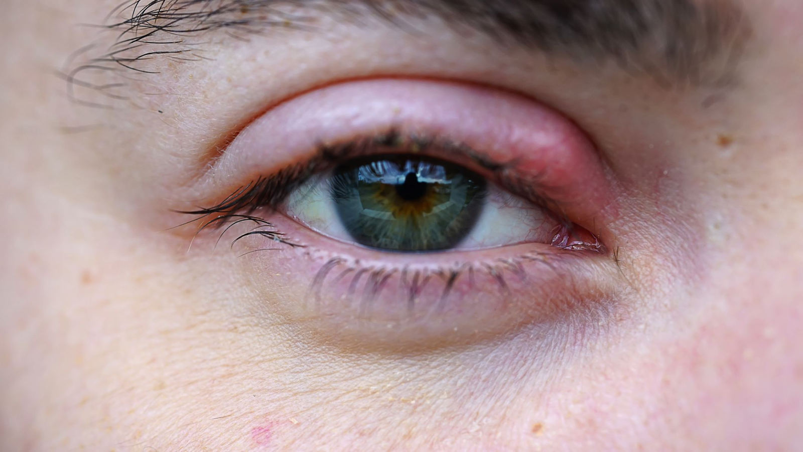 Styes: See How to Treat Prevent Painful Stye Eyes