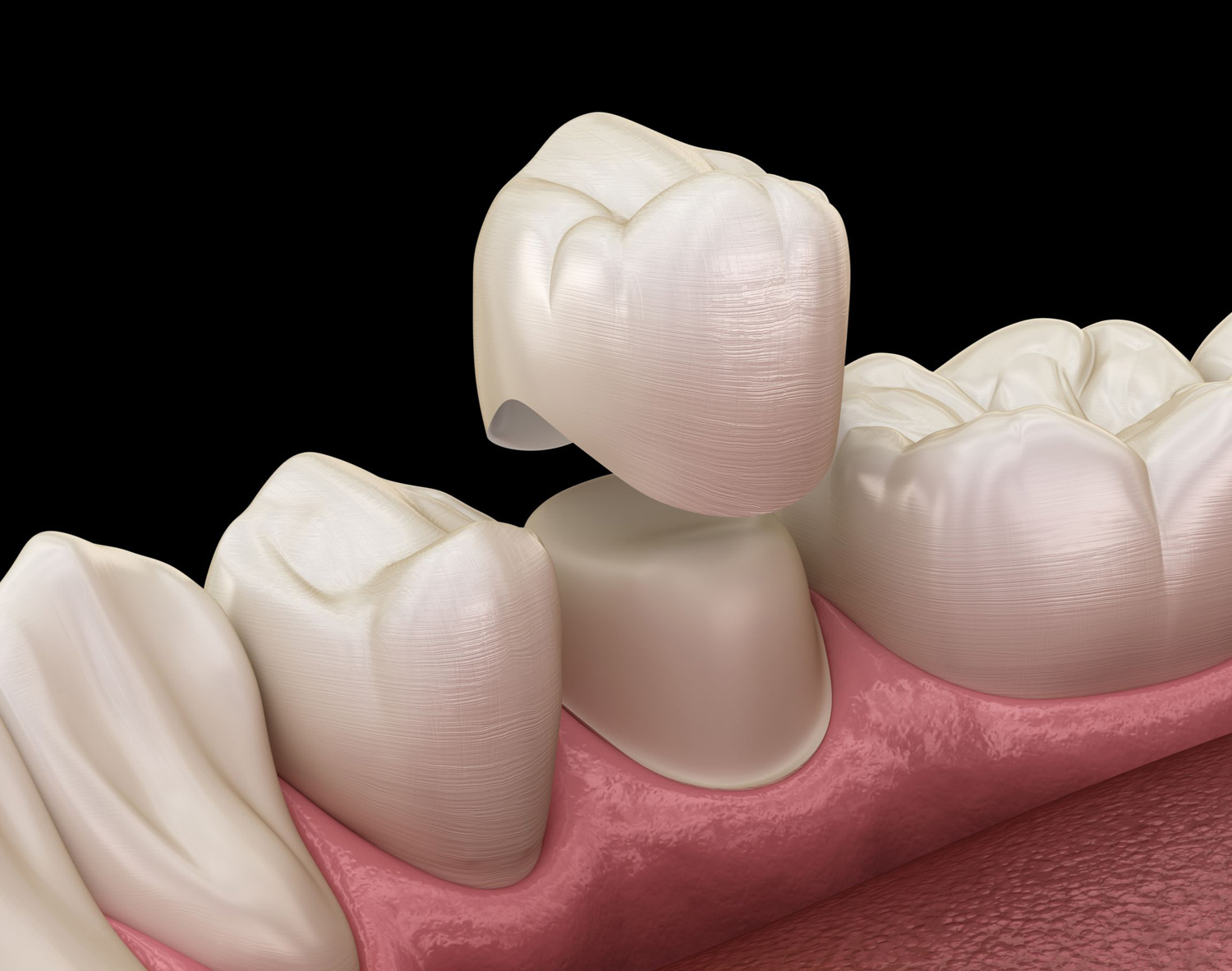 Get Restorative Crowns and Bridges in West Houston, TX At This Dental Practice