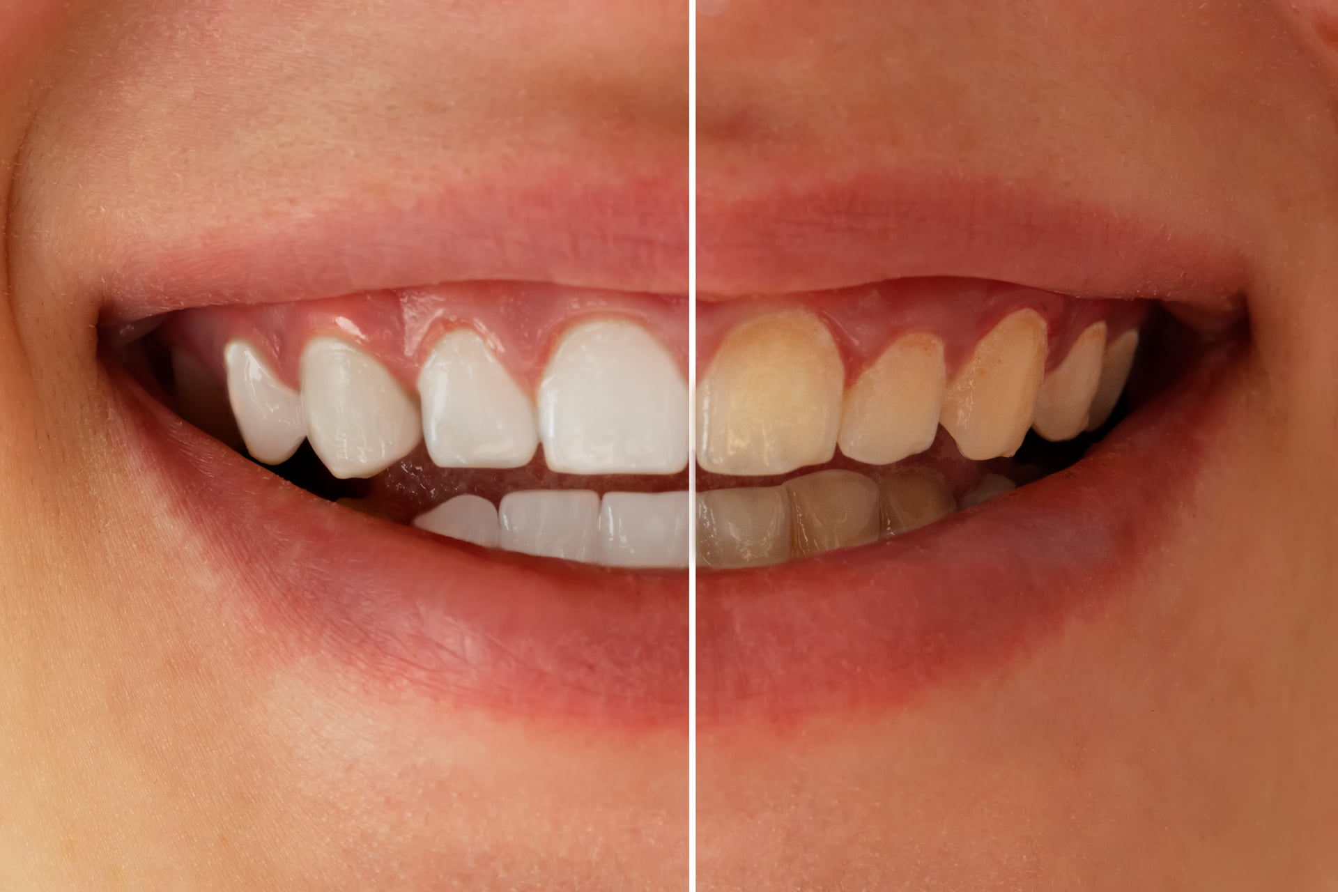 How to Whiten Aging Yellow Teeth: Tips & Procedure Explained by Nottingham Pro