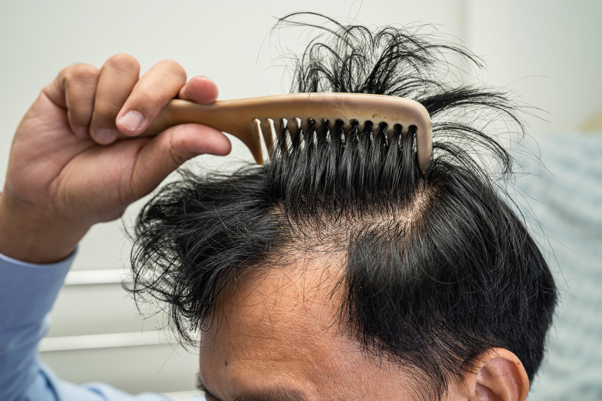 Can Testosterone Therapy Trigger Hair Follicle Shrinkage? Side Effects Explained