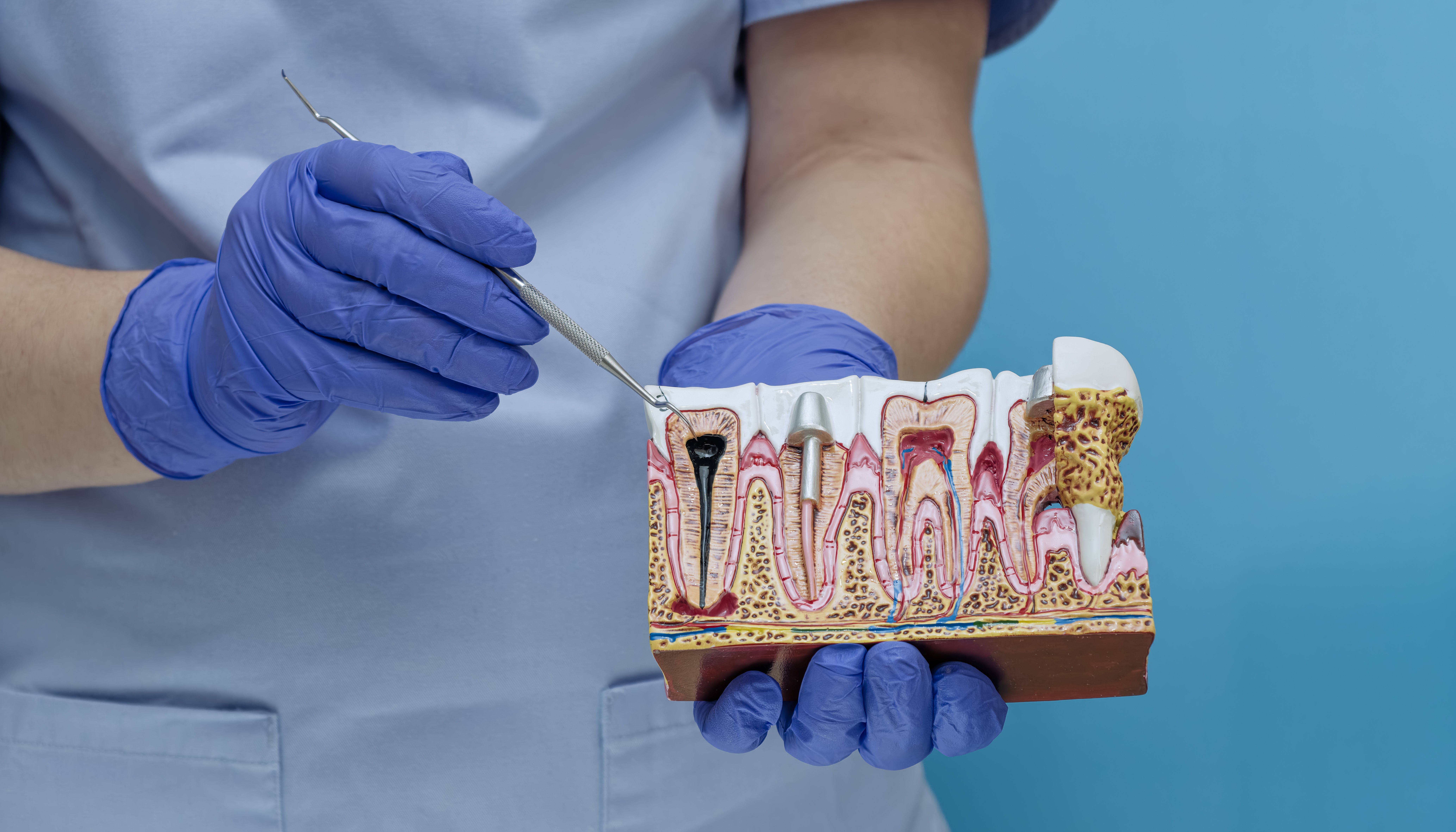 Root Canal Treatment in Nottingham: Prices, Procedure & Results