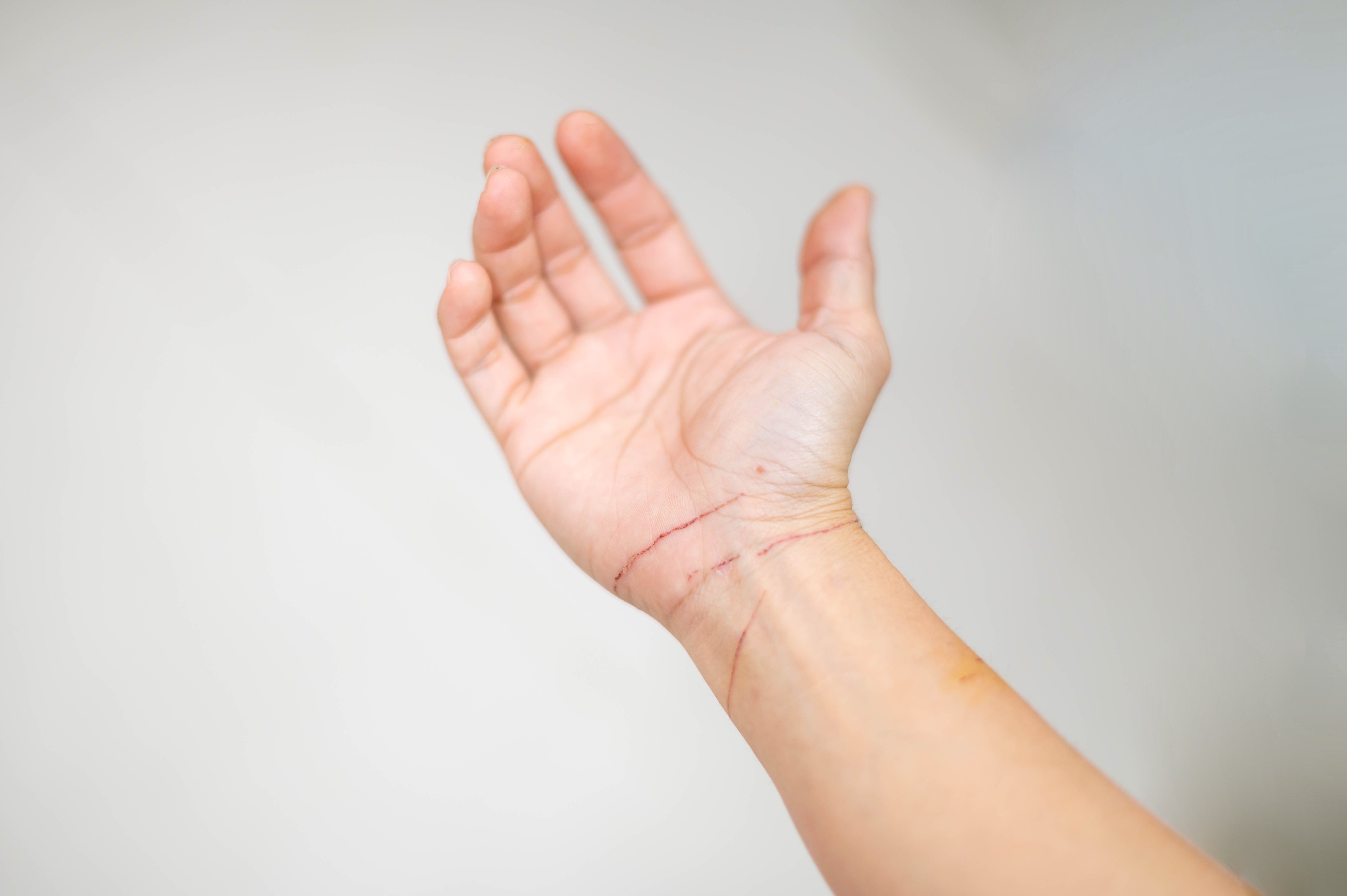 6 Warning Signs of Self-Harm in Teens That Parents Should Know