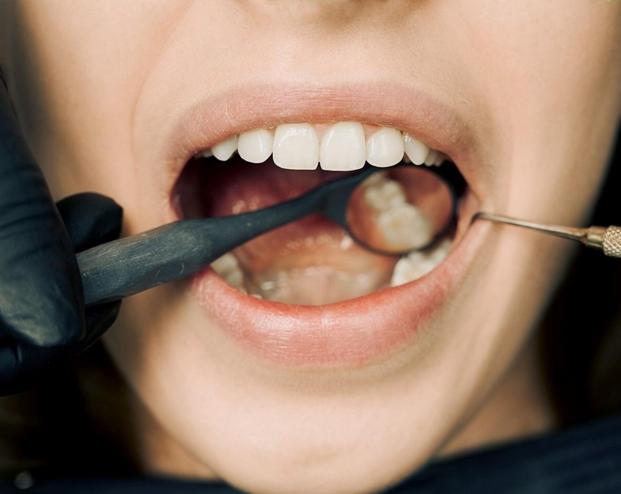Akron Cosmetic Dentist Can Whiten Your Severely Discolored Teeth In One Visit