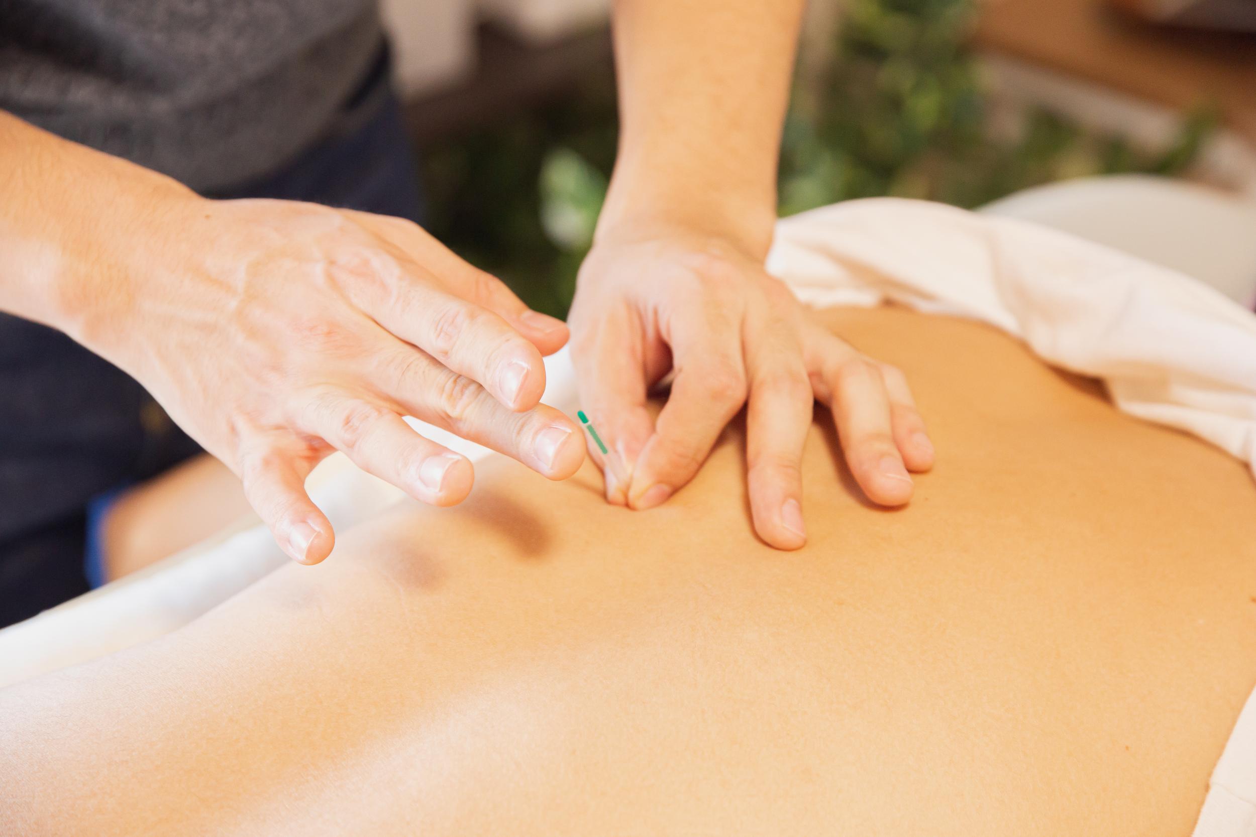 Find Lasting Pain Relief With Traditional Chinese Acupuncture In Olivenhain, CA